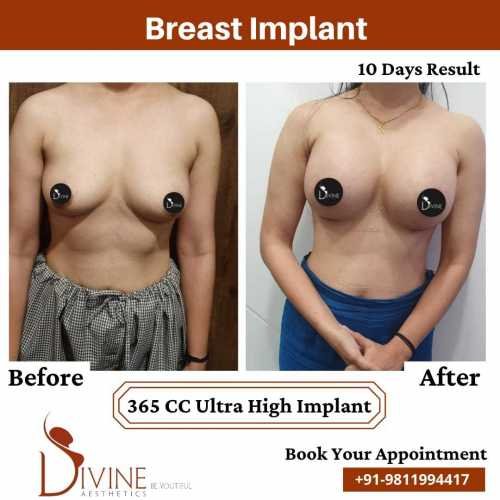 Breast-Implant-Before-After-10-Feb-22