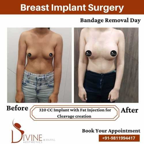 Breast-Implant-Before-After-11