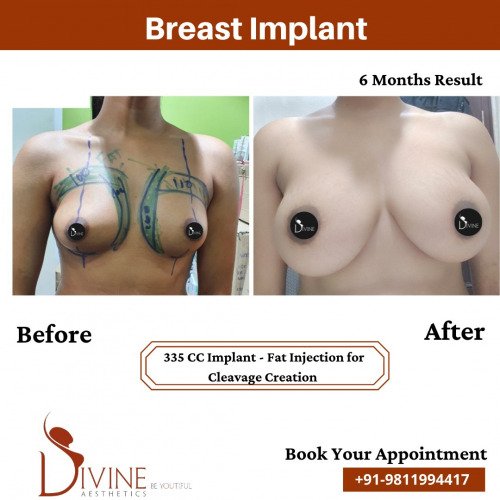 Breast-Implant-Before-After-12-Feb-22