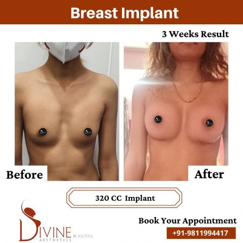 Breast-Implant-Before-After-13-Feb-22