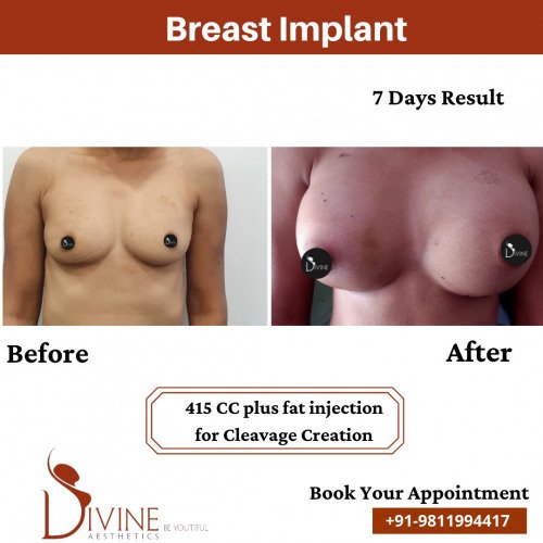 Breast-Implant-Before-After-14-Feb-22