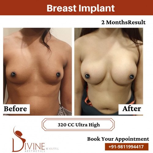 Breast-Implant-Before-After-15-Feb-22