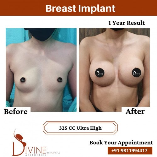 Breast-Implant-Before-After-2-Feb-22