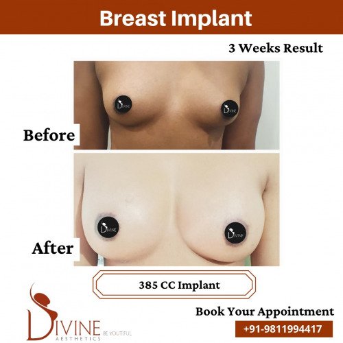 Breast-Implant-Before-After-3-Feb-22