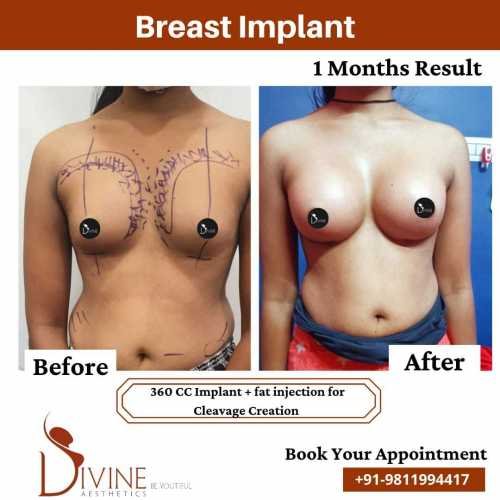 Breast-Implant-Before-After-3
