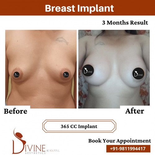 Breast-Implant-Before-After-4-Feb-22