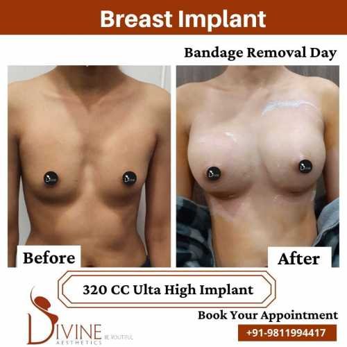 Breast-Implant-Before-After-4