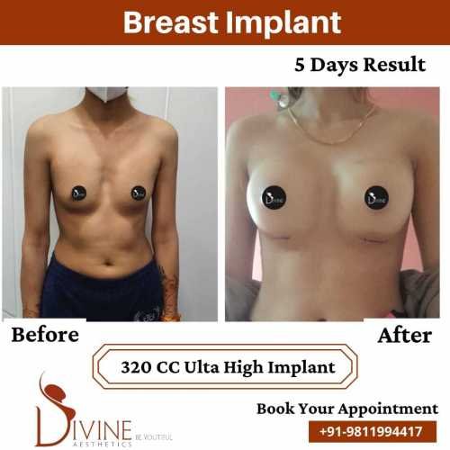 Breast-Implant-Before-After-5