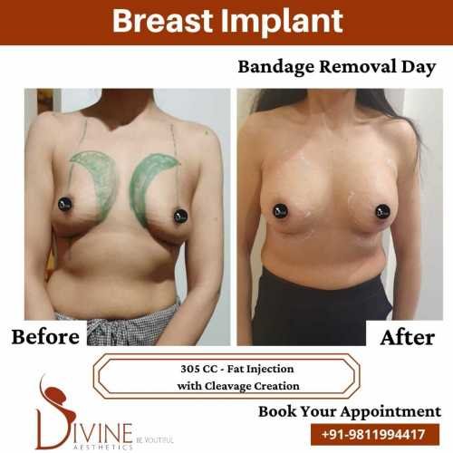 Breast-Implant-Before-After-7