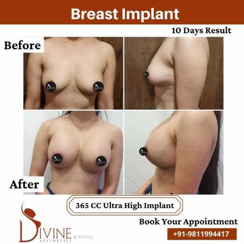 Breast-Implant-Before-After-8-Feb-22
