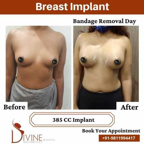 Breast-Implant-Before-After-8