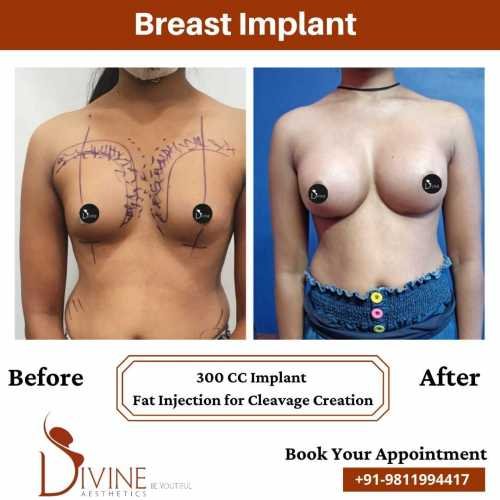 Breast-Implant-Before-After-9-Feb-22