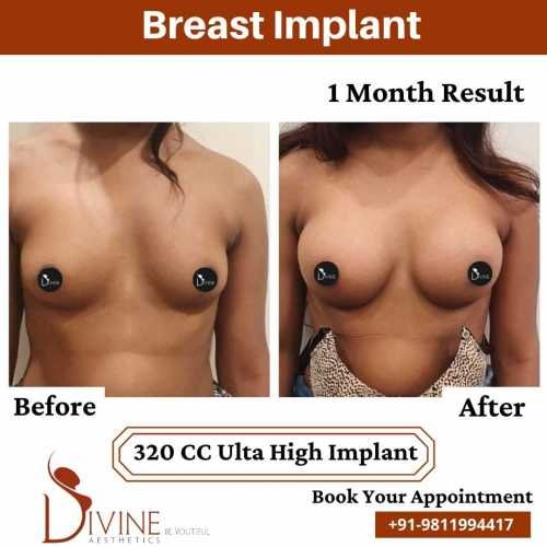 Breast-Implant-Before-After-9