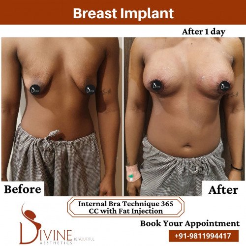 Breast-Implant-before-after-1-March-2022