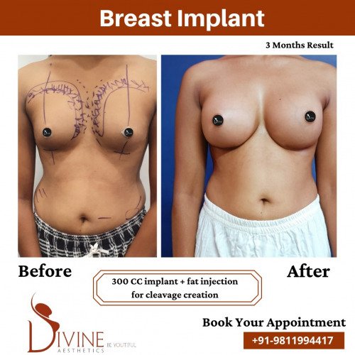 Breast-Implant-before-after-10-March-2022