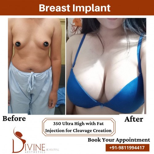 Breast-Implant-before-after-11-March-2022