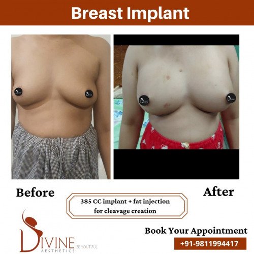 Breast-Implant-before-after-12-March-2022