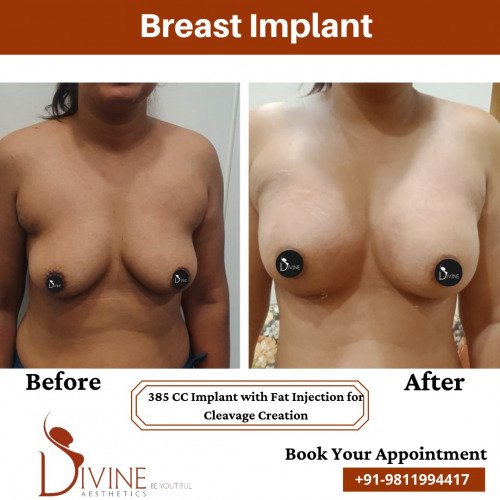 Breast-Implant-before-after-14-March-2022