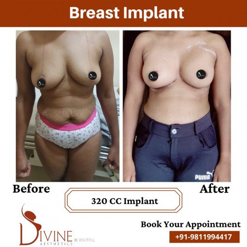 Breast-Implant-before-after-15-March-2022