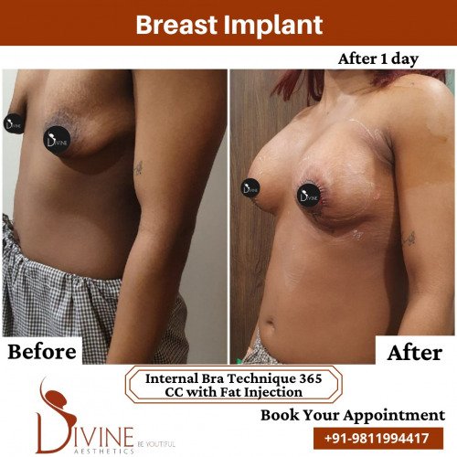Breast-Implant-before-after-2-March-2022
