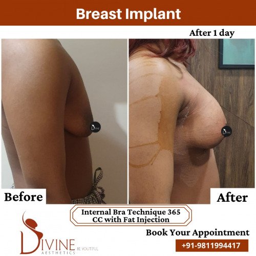Breast-Implant-before-after-3-March-2022