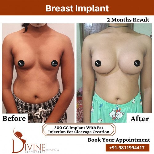 Breast-Implant-before-after-4-March-2022