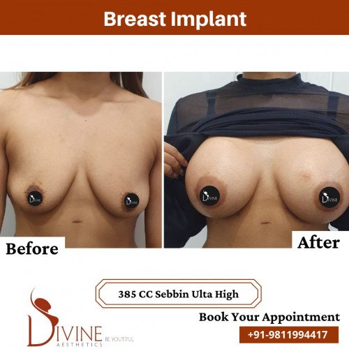 Breast-Implant-before-after-5-March-2022