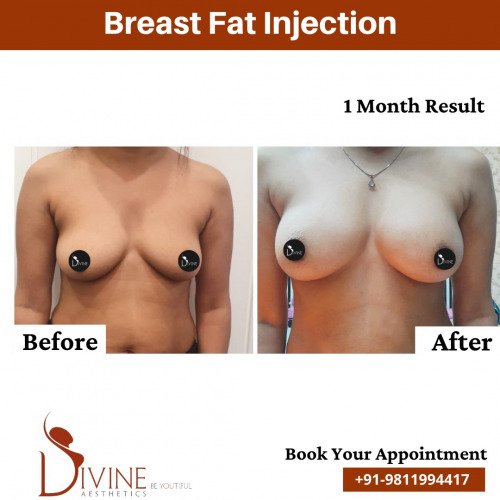 Breast-Implant-before-after-6-March-2022
