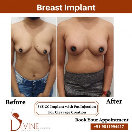 Breast-Implant-before-after-7-March-2022