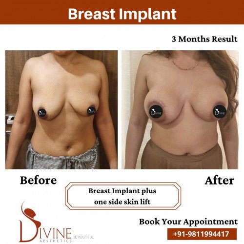 Breast-Implant-before-after-8-March-2022