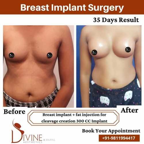 Breast-Implant-Before-After