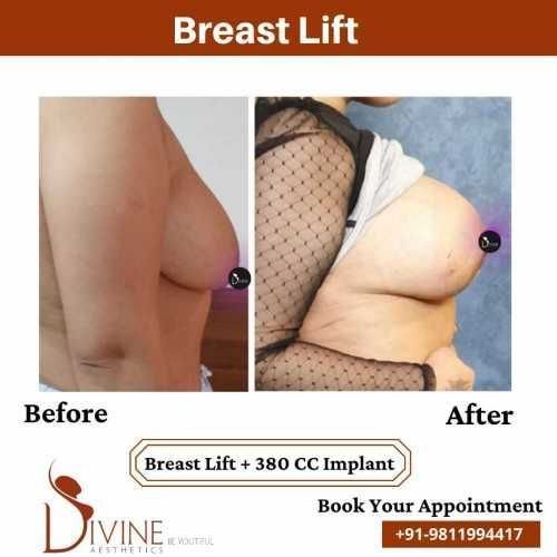 1_Breast-Lift-1.jpeg-nggid03422-ngg0dyn-500x500x100-00f0w010c010r110f110r010t010