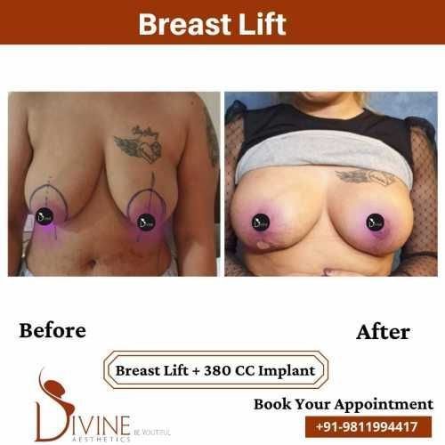 1_Breast-Lift-2.jpeg-nggid03421-ngg0dyn-500x500x100-00f0w010c010r110f110r010t010