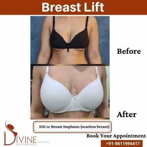 Breast-Lift-1.jpeg-nggid03337-ngg0dyn-500x500x100-00f0w010c010r110f110r010t010