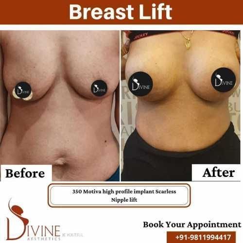 Breast-Lift-2.jpeg-nggid03339-ngg0dyn-500x500x100-00f0w010c010r110f110r010t010