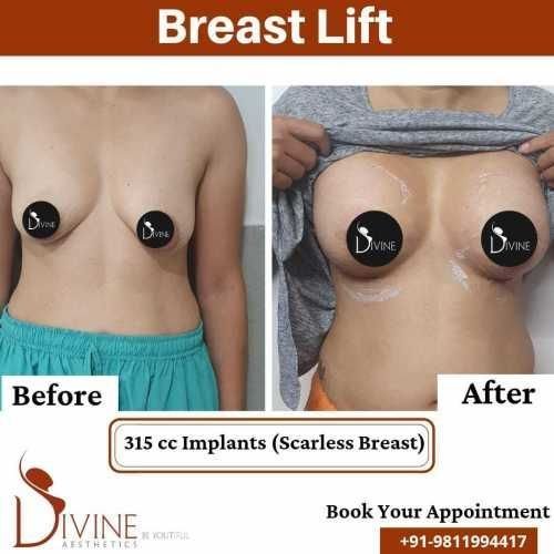 Breast-Lift-3.jpeg-nggid03340-ngg0dyn-500x500x100-00f0w010c010r110f110r010t010