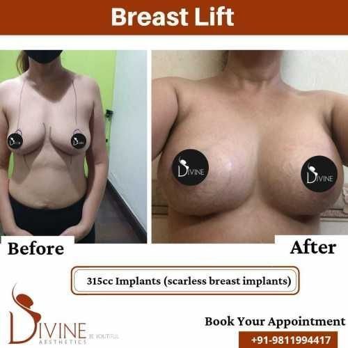 Breast-Lift-5.jpeg-nggid03342-ngg0dyn-500x500x100-00f0w010c010r110f110r010t010