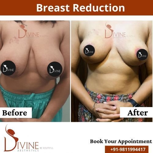 Breast-Reduction-1.png-nggid0218-ngg0dyn-500x500x100-00f0w010c010r110f110r010t010