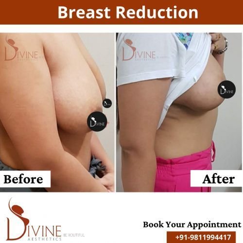 Breast-Reduction-2.png-nggid0217-ngg0dyn-500x500x100-00f0w010c010r110f110r010t010