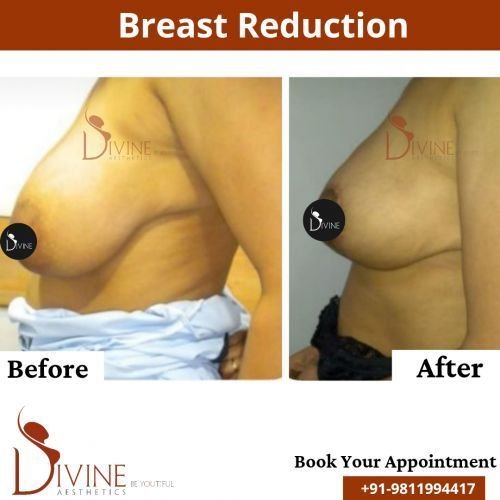 Breast-Reduction-3.png-nggid0216-ngg0dyn-500x500x100-00f0w010c010r110f110r010t010