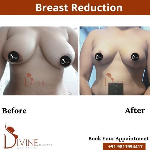 Breast-Reduction-4.png-nggid0215-ngg0dyn-500x500x100-00f0w010c010r110f110r010t010