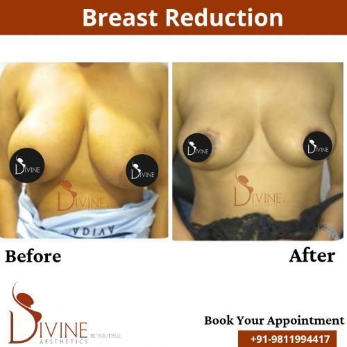 Breast-Reduction-5.png-nggid0214-ngg0dyn-500x500x100-00f0w010c010r110f110r010t010