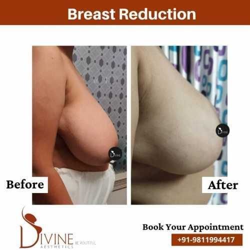 Breast-Reduction-Before-After-6-Feb-22.jpeg-nggid03467-ngg0dyn-500x500x100-00f0w010c010r110f110r010t010
