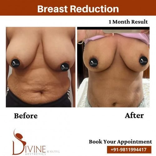 Breast-Reduction-before-after-1-March-2022.jpeg-nggid03503-ngg0dyn-500x500x100-00f0w010c010r110f110r010t010