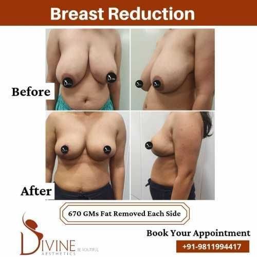 Breast-Reduction-before-after-jan-1.jpeg-nggid03443-ngg0dyn-500x500x100-00f0w010c010r110f110r010t010