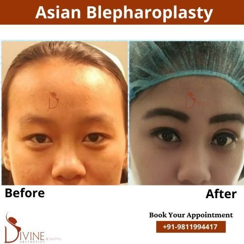 Asian-Blepharoplasty-1.png-nggid0291-ngg0dyn-500x500x100-00f0w010c010r110f110r010t010