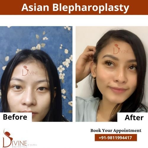 Asian-Blepharoplasty-2.png-nggid0292-ngg0dyn-500x500x100-00f0w010c010r110f110r010t010