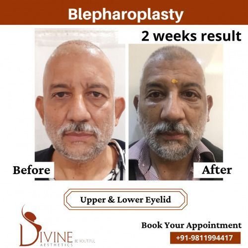 Blepharoplasty-Before-After-2-Feb-22.jpeg-nggid03484-ngg0dyn-500x500x100-00f0w010c010r110f110r010t010