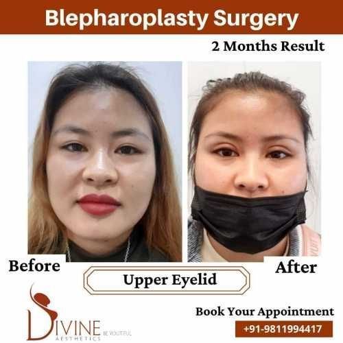 Blepharoplasty-before-after-jan-1.jpeg-nggid03442-ngg0dyn-500x500x100-00f0w010c010r110f110r010t010
