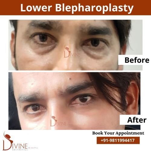 Lower-Blepharoplasty-1.png-nggid0289-ngg0dyn-500x500x100-00f0w010c010r110f110r010t010